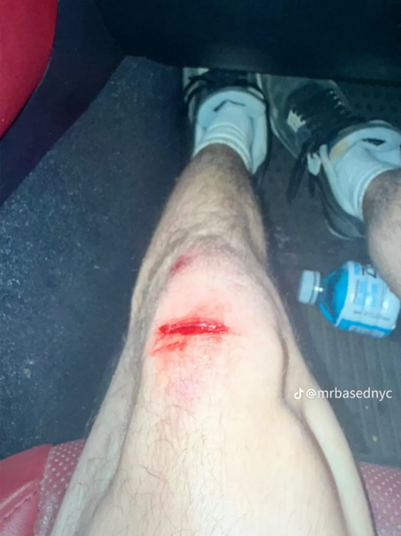 File:Joshs horribly mangled knee.png